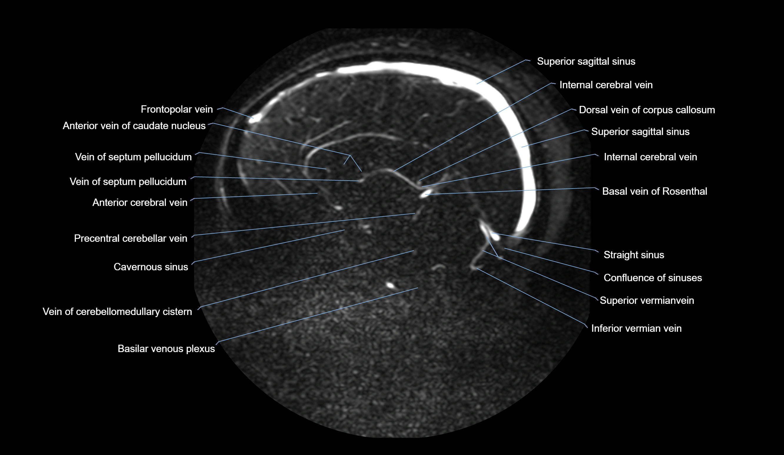 MRV brain sagittal anatomy 3T MRI images -img-01015-00045.webp